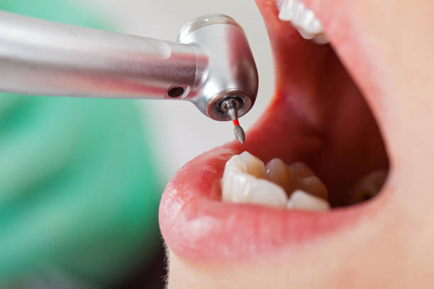 Best Emergency Tooth Extraction in Agler Beach, FL